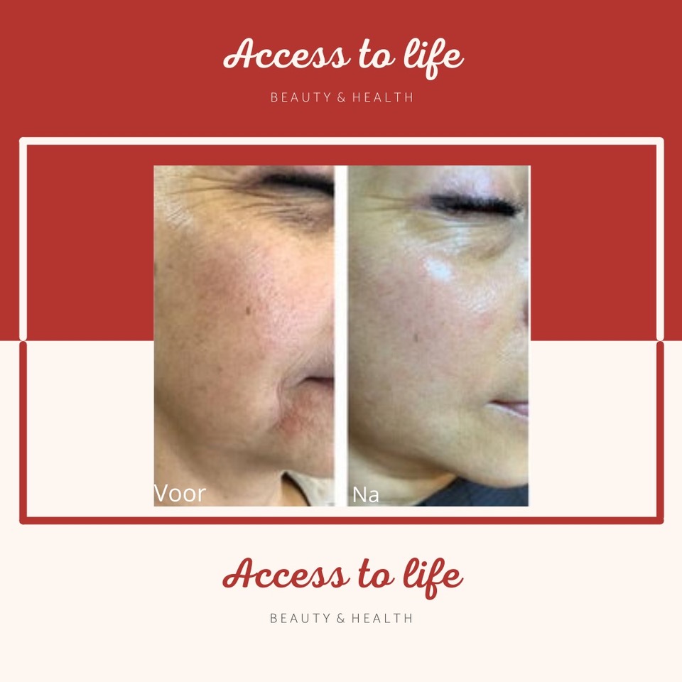 PURWAVE AMSTERDAM ACCESS TO LIFE Gezichtsverjonging VOOR EN NA PURWAVE