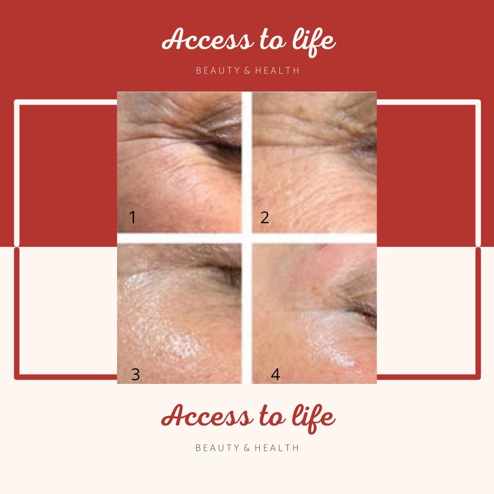 PURWAVE AMSTERDAM ACCESS TO LIFE GEZICHTSVERJONGING EN OOGLIFTING PURWAVE