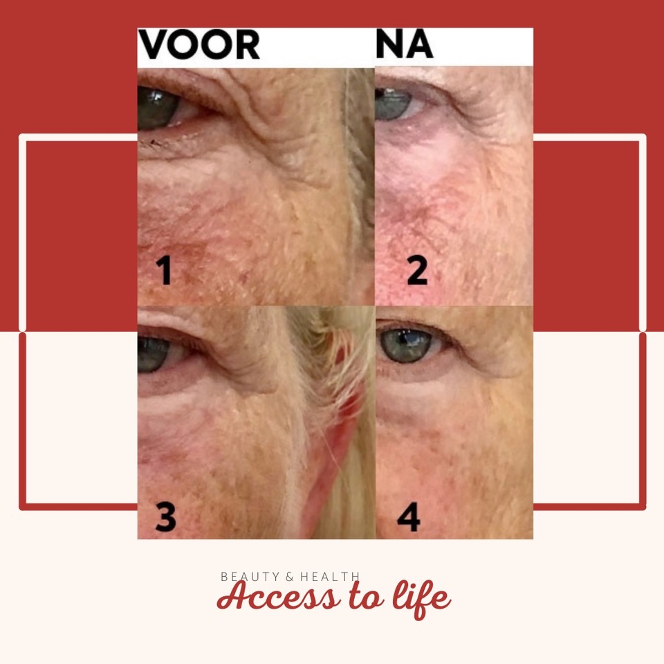 Gezichtsverjonging voor en na